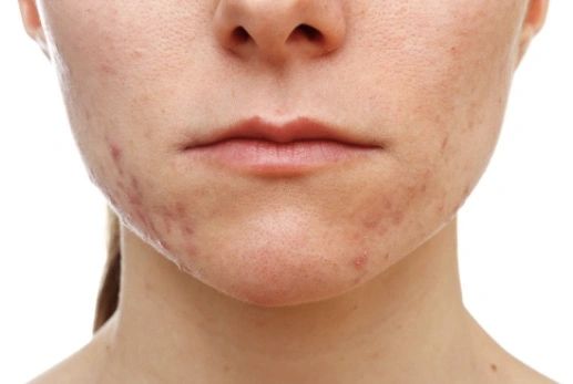 Featured image for article: Acne: Tips to Help You See Clearer Skin