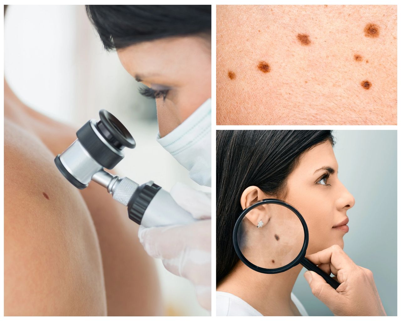 Featured image for article: Atypical Moles and Melanoma Risk: Understanding Dysplastic Nevi