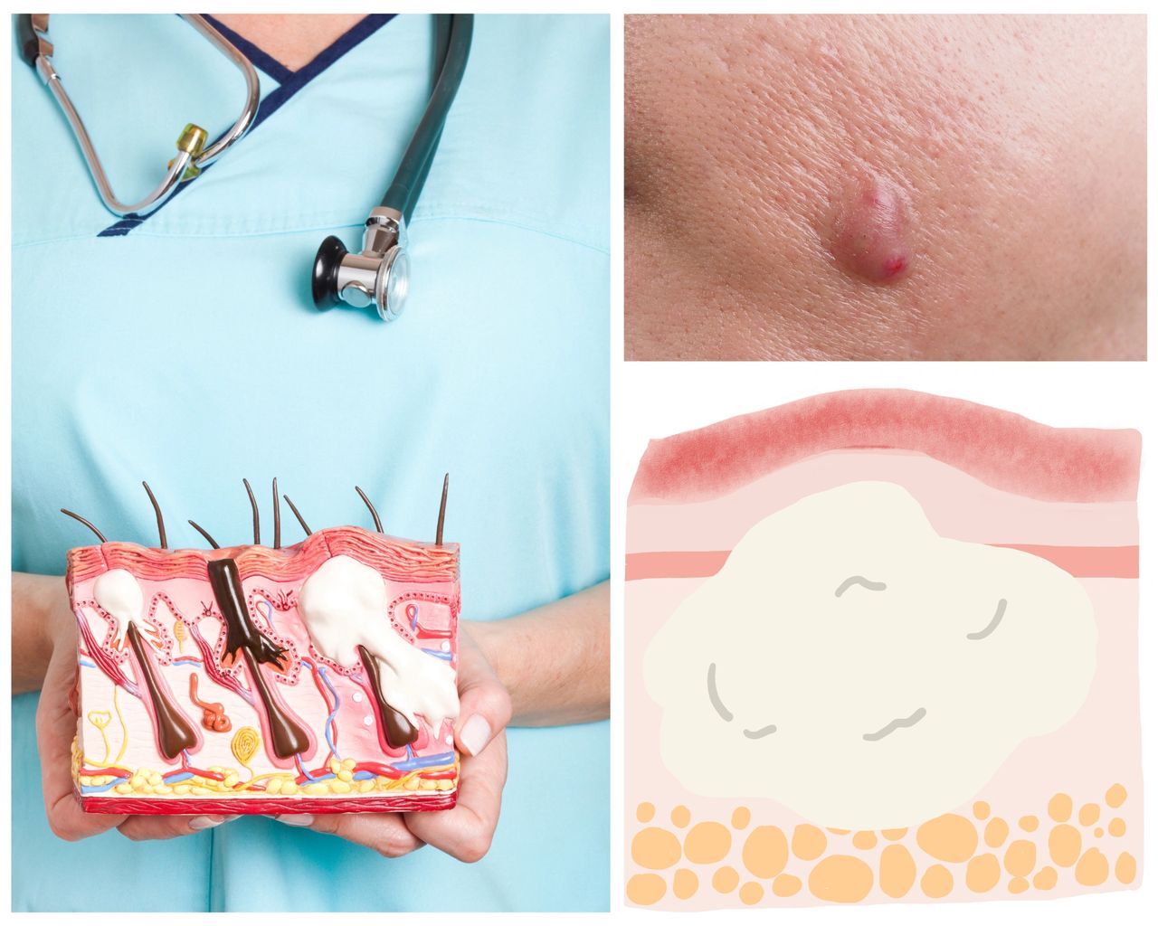 Featured image for article: Cystic Acne: A Guide to Causes, Symptoms, and Advanced Treatments