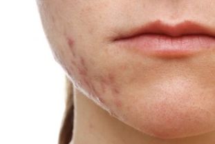Featured image for article: Discover the Truth About Acne in Our Latest YouTube Video