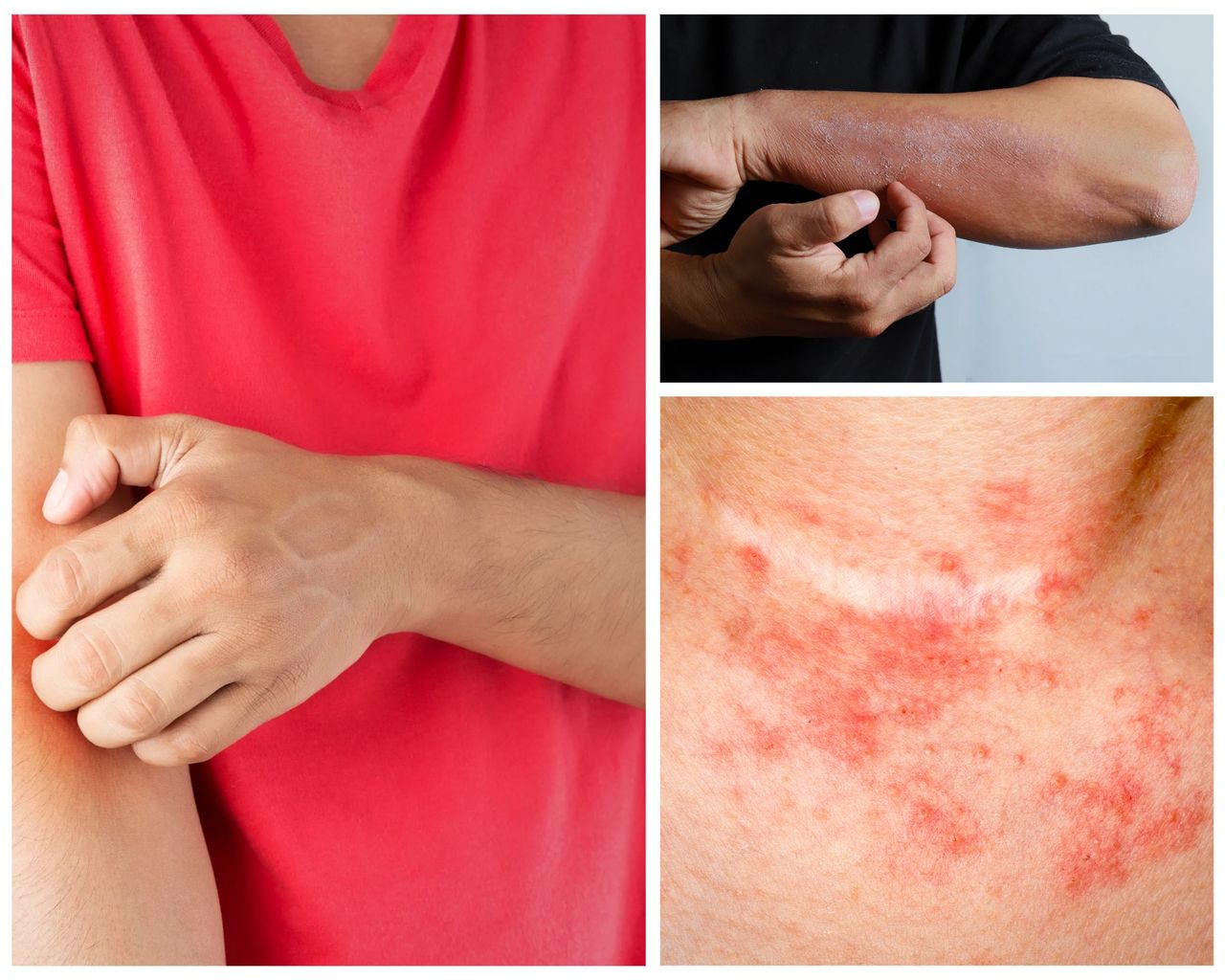 Featured image for article: Eczema: Why Seeing a Board-Certified Dermatologist Is Essential