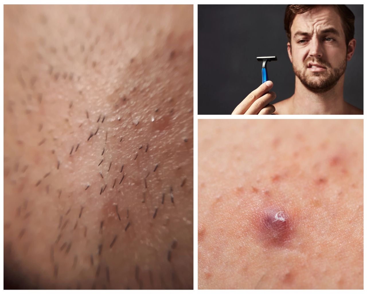 Featured image for article: Effective Strategies for Treating and Preventing Ingrown Hairs