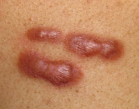 Featured image for article: Keloids: How to prevent these raised scars