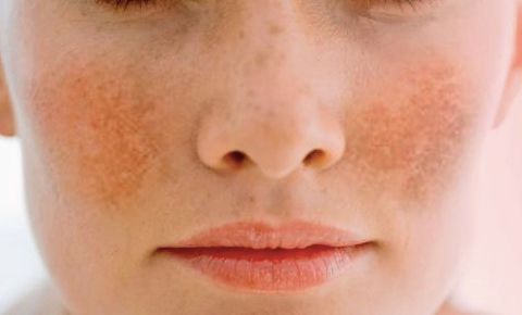 Featured image for article: Melasma: Tips to Make It Less Noticeable