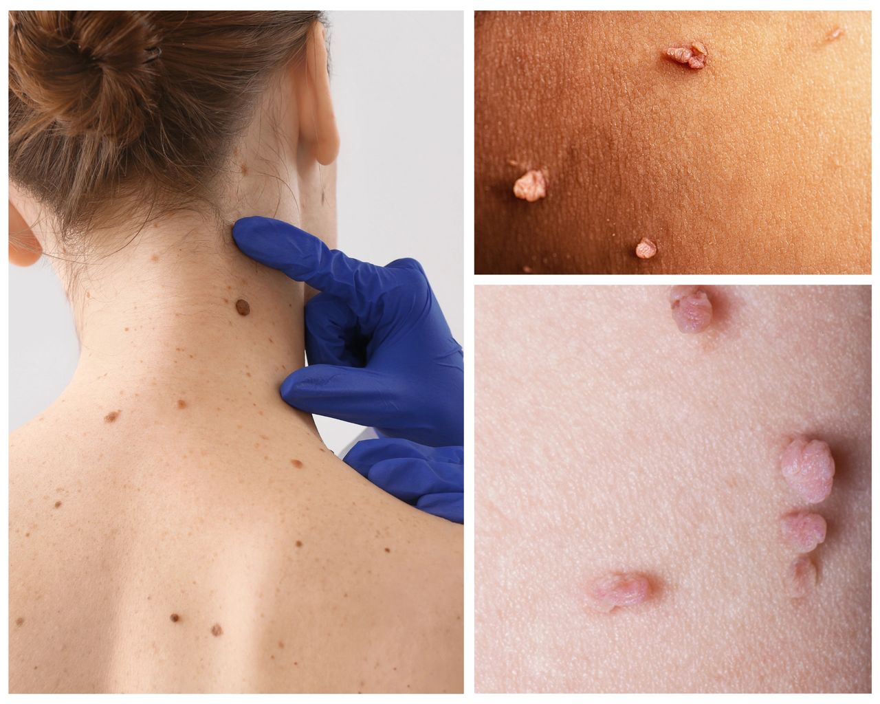 Featured image for article: Moles vs. Skin Tags: Deciphering Your Skin's Mysteries