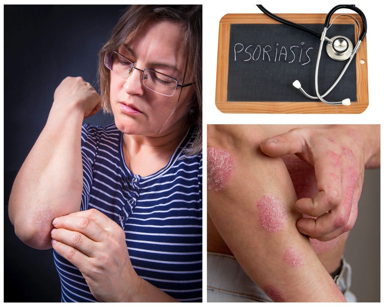 Featured image for article: Predicting Psoriasis Relapse After Stopping Biologic Therapy