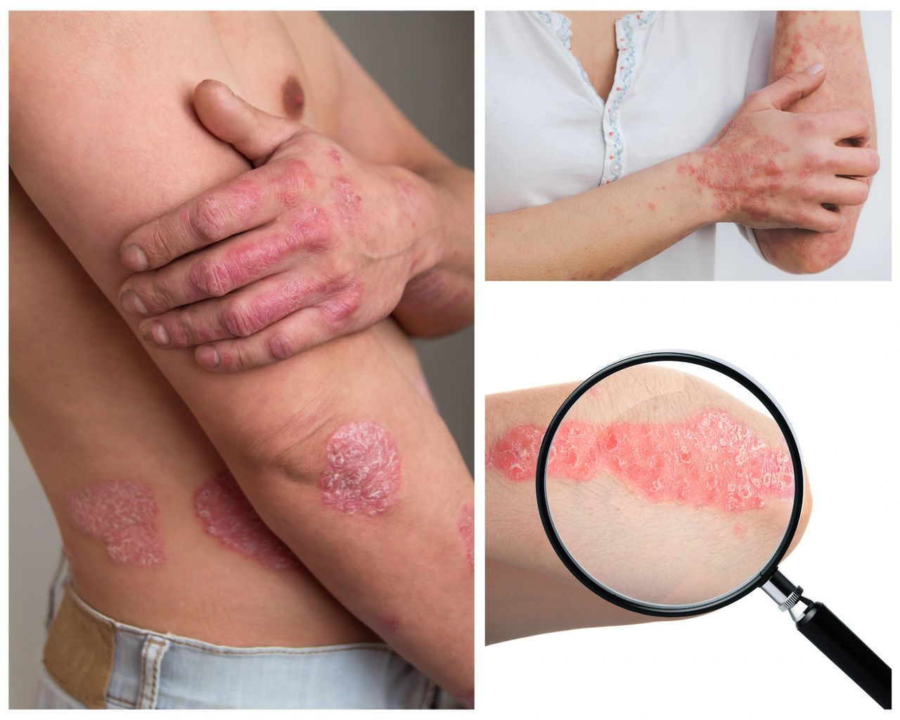 Featured image for article: Psoriasis: Types, Causes, and Treatments