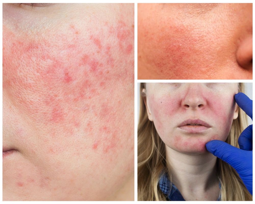Featured image for article: The Importance of Treating Rosacea