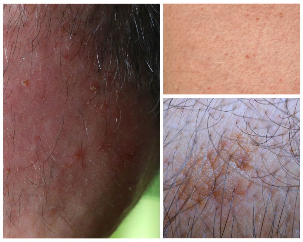 Featured image for article: Understanding Actinic Keratosis