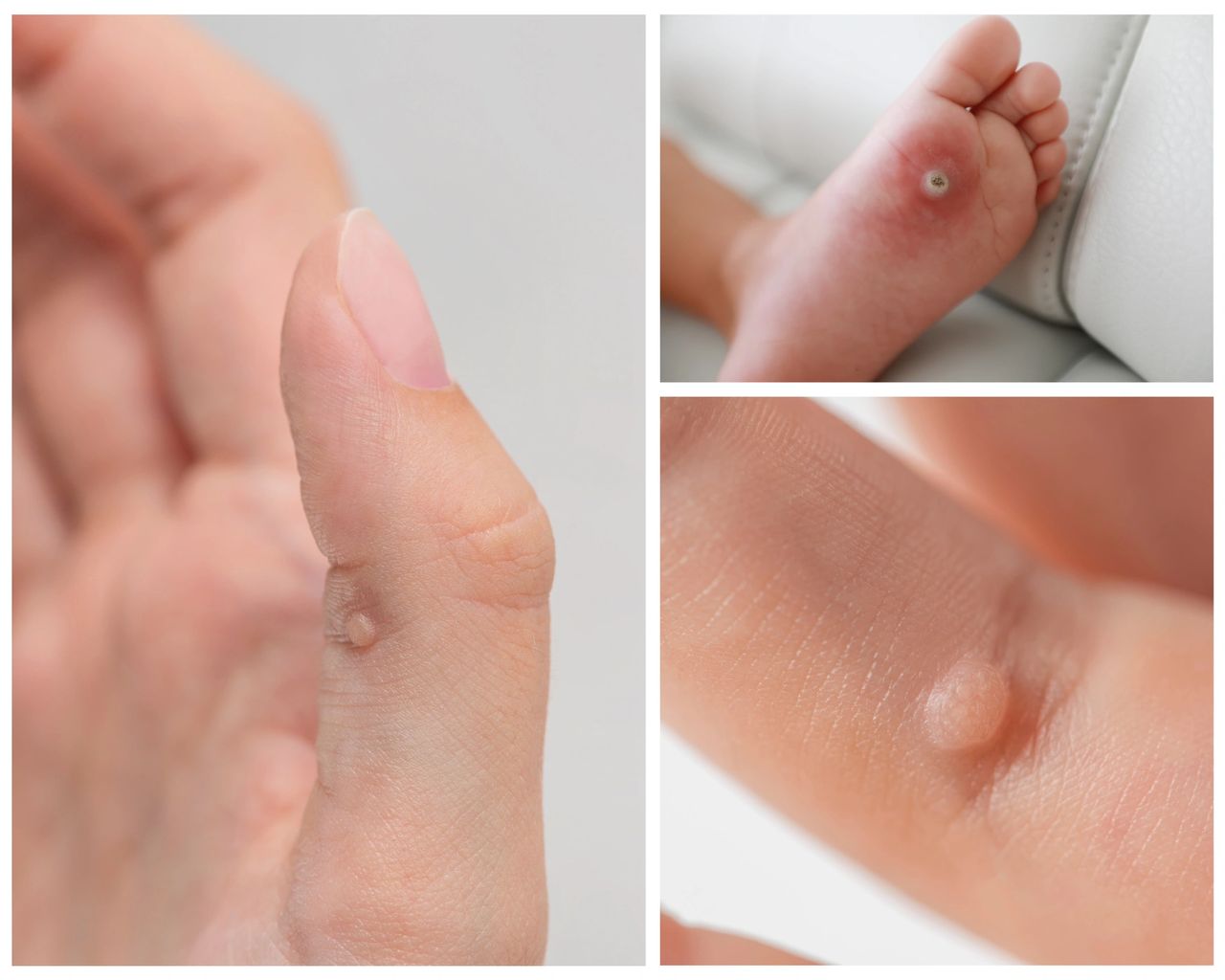 Featured image for article: Understanding Warts: Causes, Transmission, and Treatment Options