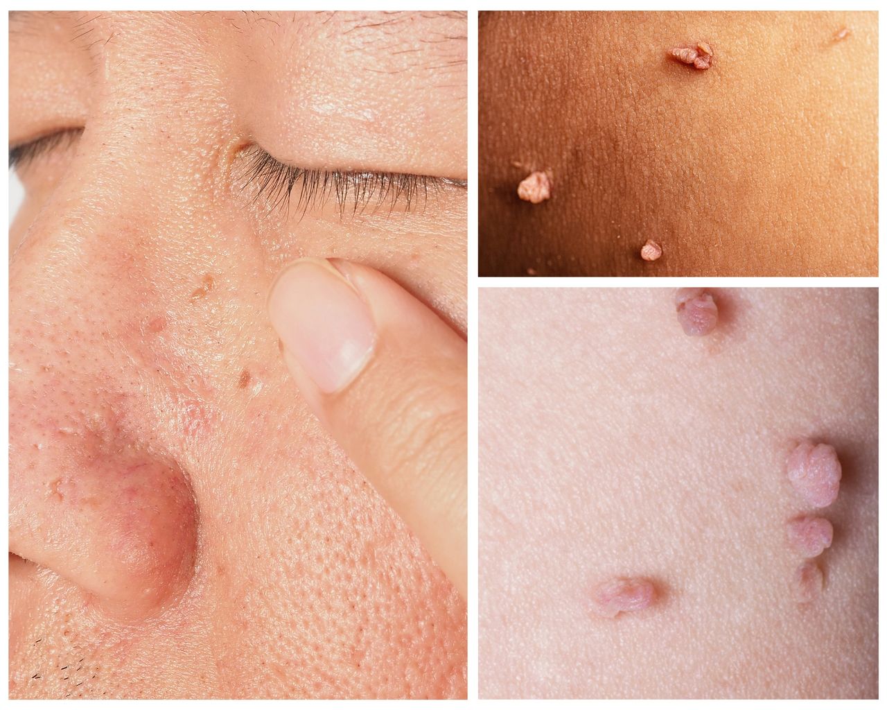 Featured image for article: What is the best way to remove a skin tag?